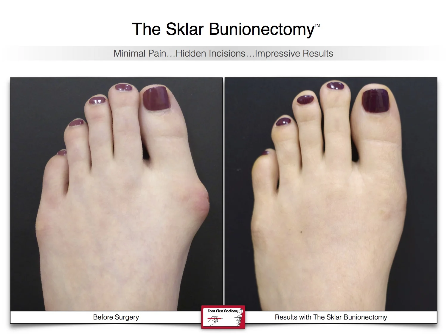 bunion-surgery-before-and-after-sklar-bunionectomy-19.jpg