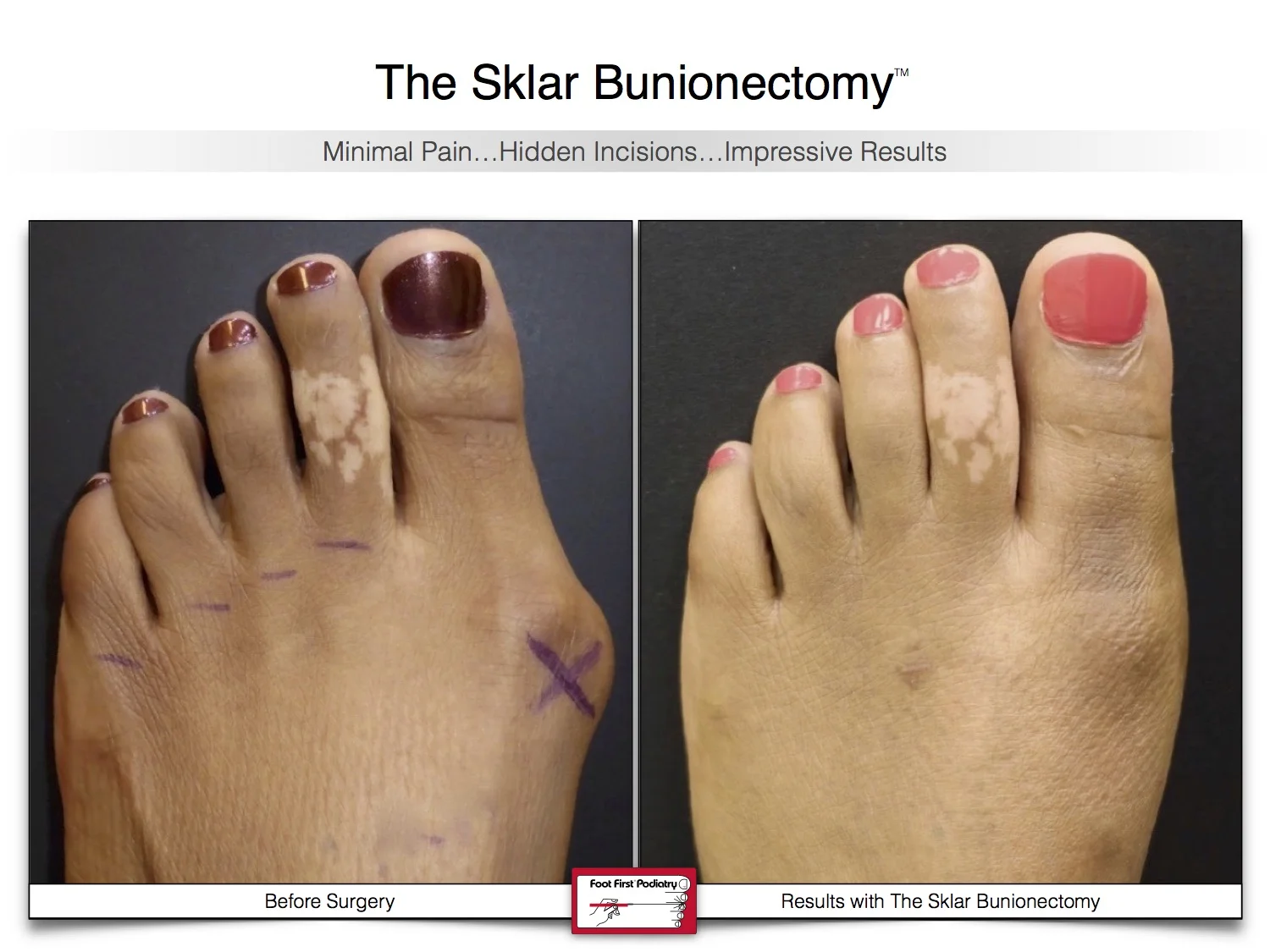 bunion-surgery-before-and-after-sklar-bunionectomy-90.jpg