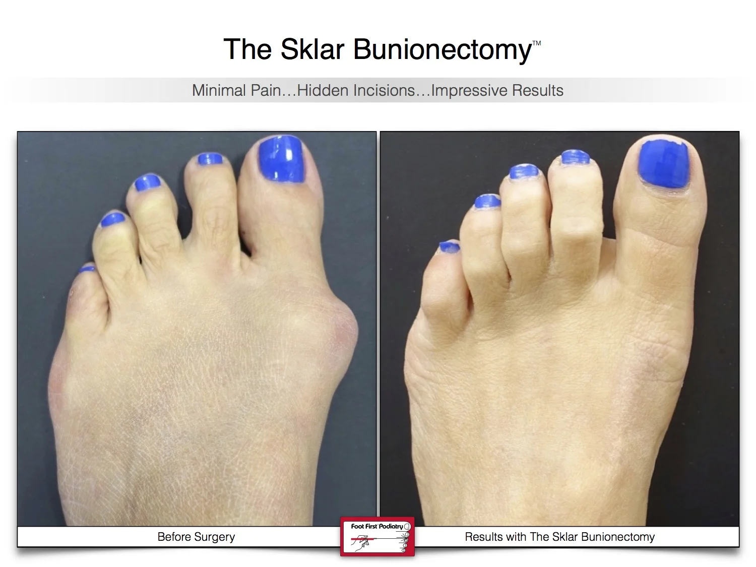 bunion-surgery-before-and-after-sklar-bunionectomy-91.jpg
