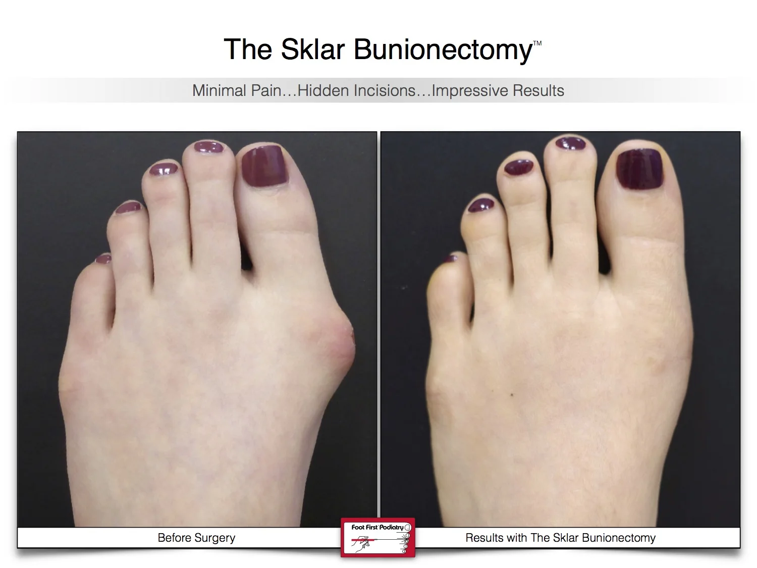 sklar-bunionectomy-before-and-after-patient-3.jpg