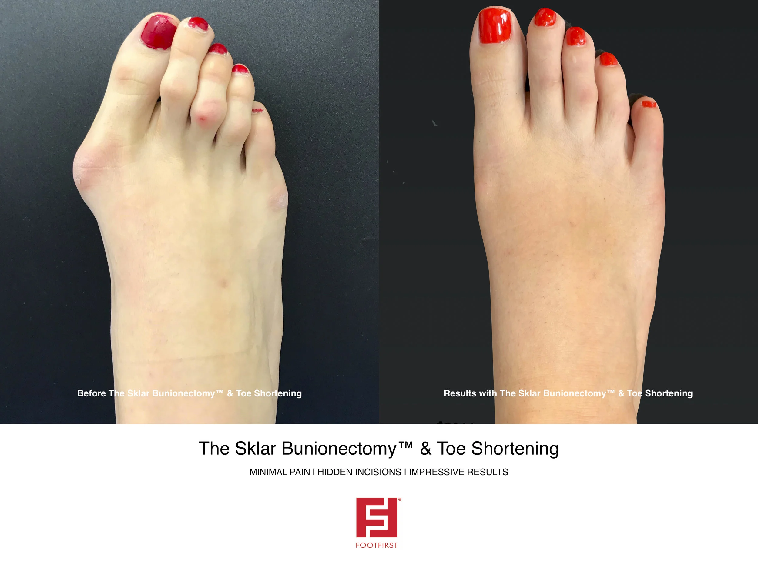 FF | www.footfirst.com - The Sklar Bunionectomy & Toe Shortening 2.jpg