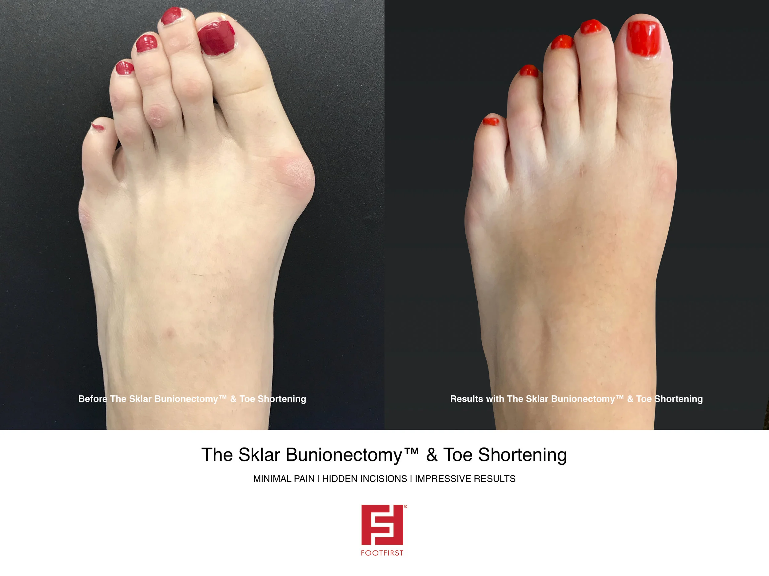 FF | www.footfirst.com - The Sklar Bunionectomy & Toe Shortening 1.jpg