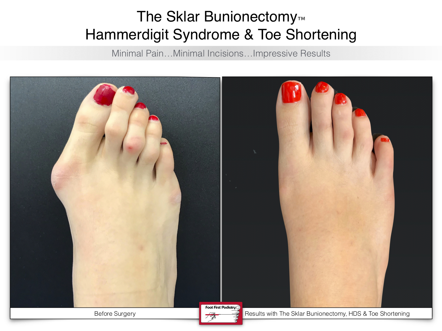 www.footfirst.com | Cosmetic Bunion and Toe Shortening Surgery 130.jpg