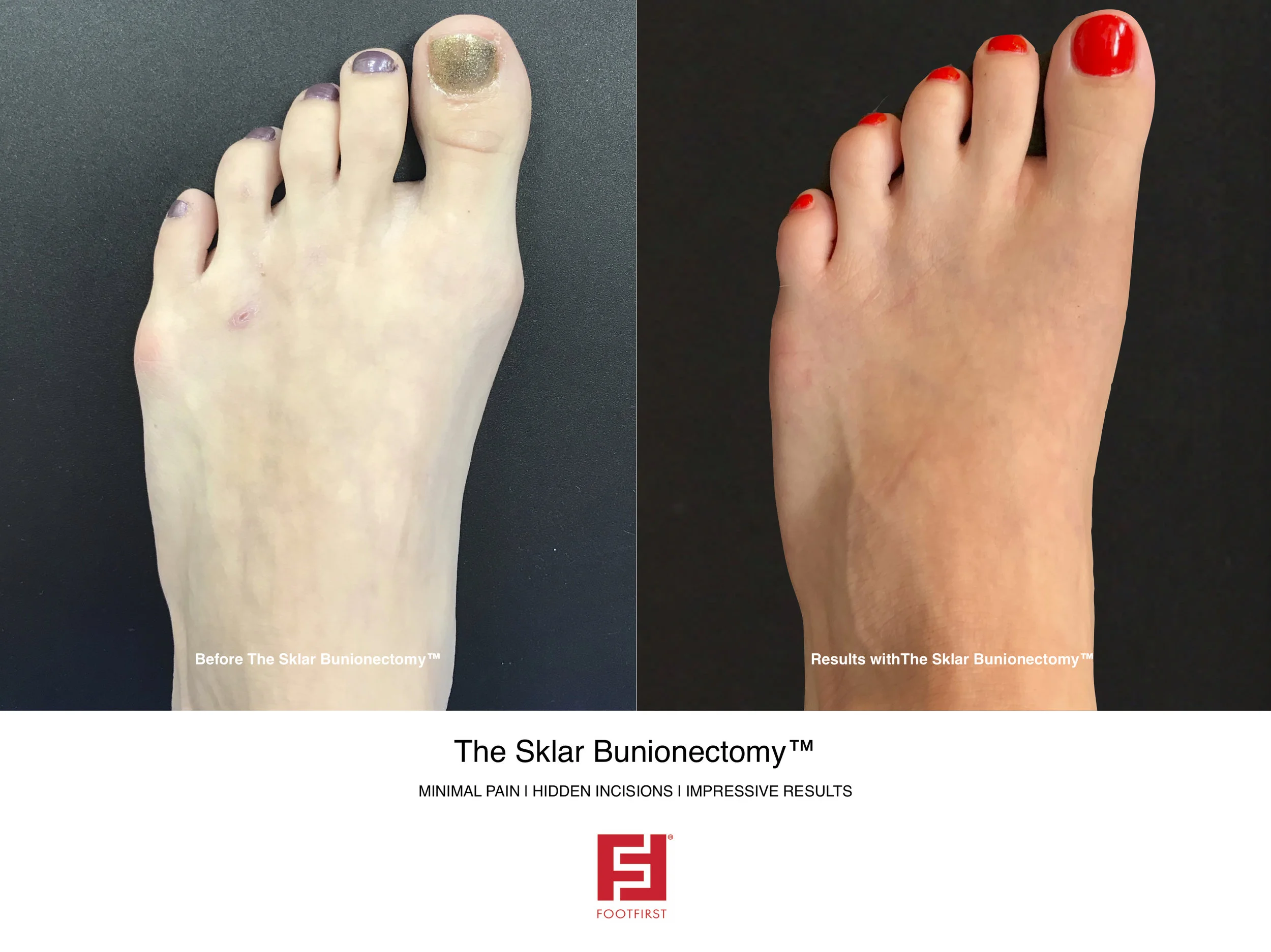FF | www.footfirst.com - The Sklar Bunionectomy & Toe Shortening 3.jpg