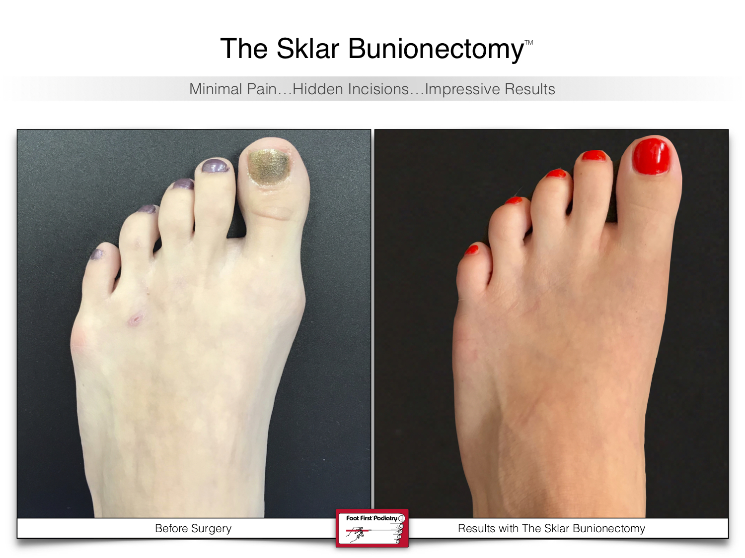 www.footfirst.com | Cosmetic Bunion and Toe Shortening Surgery 132.jpg