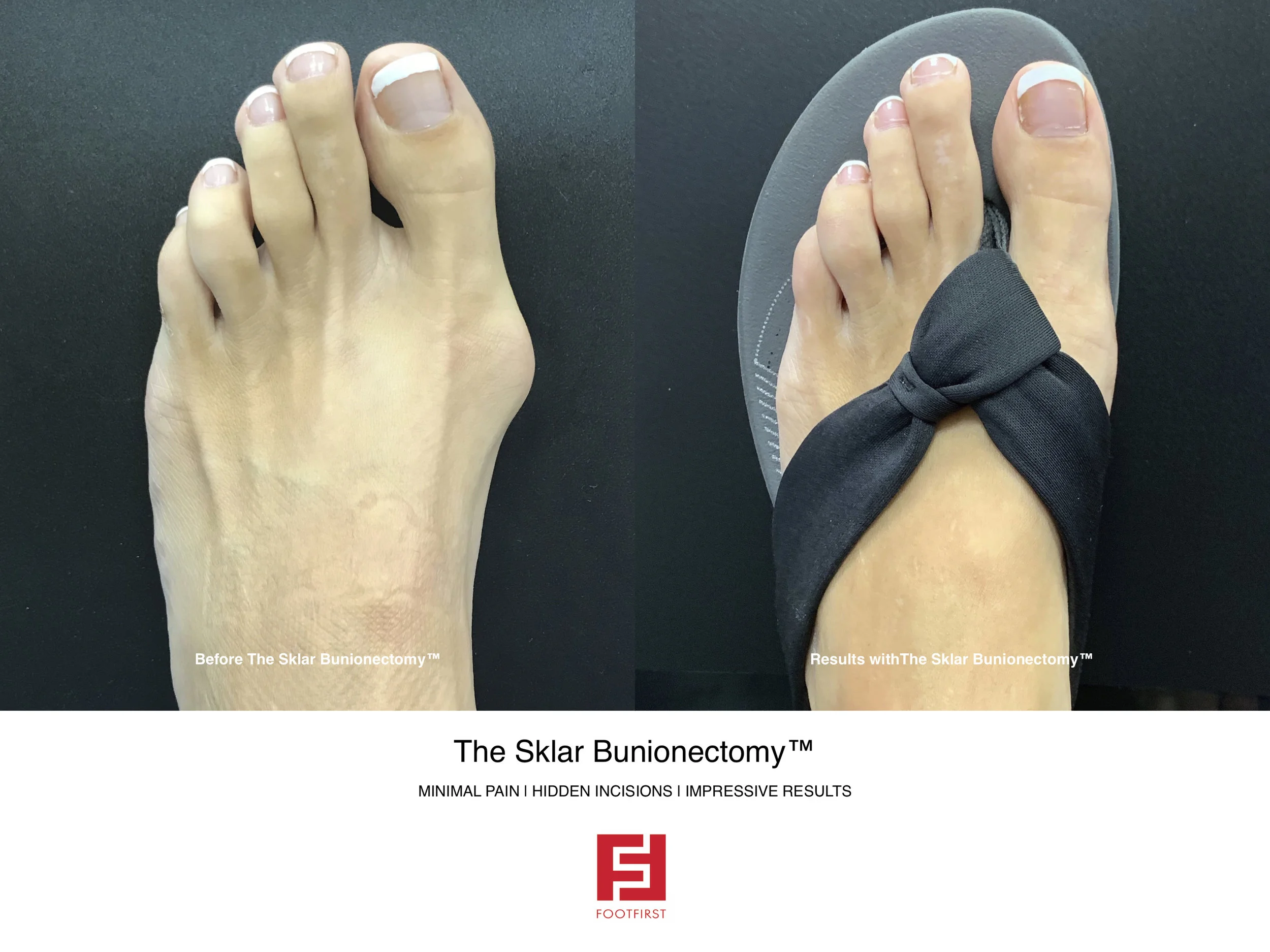 FF www.footfirst.com - The Sklar Bunionectomy & Toe Shortening 18.jpg
