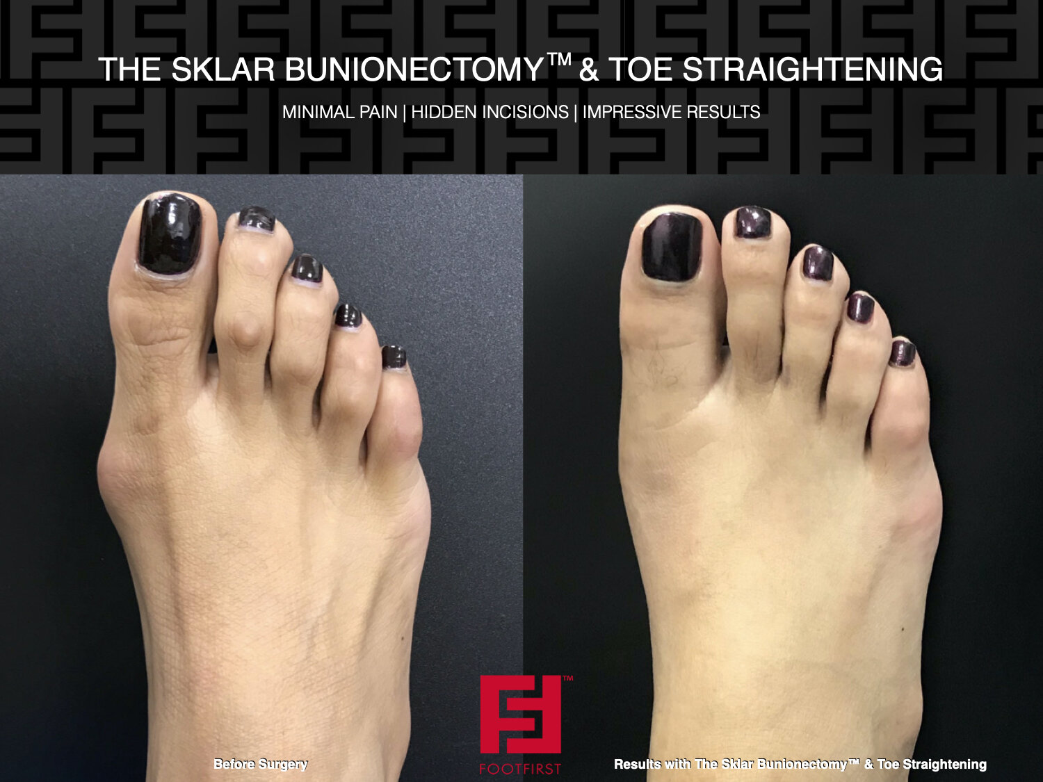 www.footfirst.com  Cosmetic Bunion and Toe Shortening Surgery WEBSITE 140.jpg