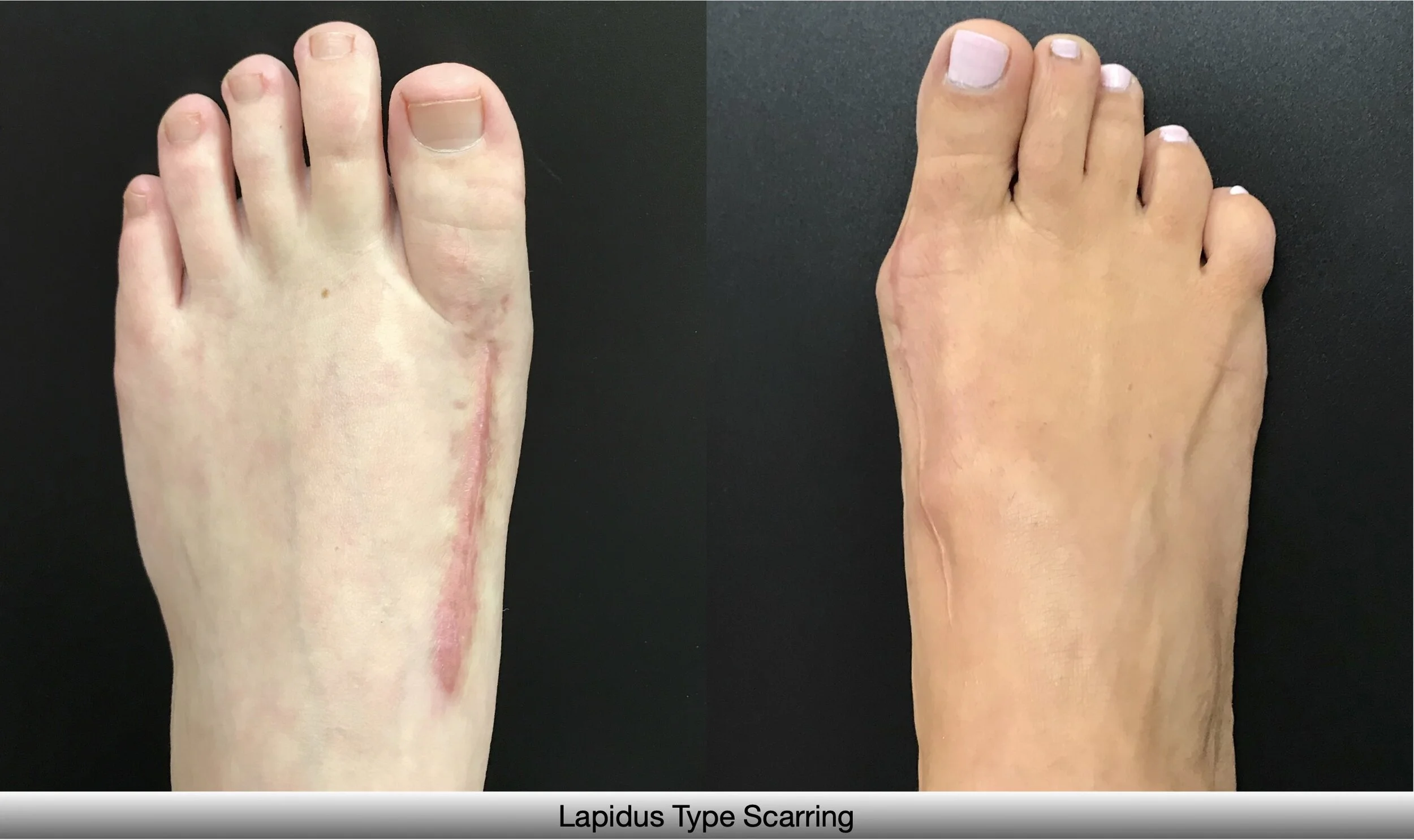 Lapidus Bunionectomy Before And After – VIIIG