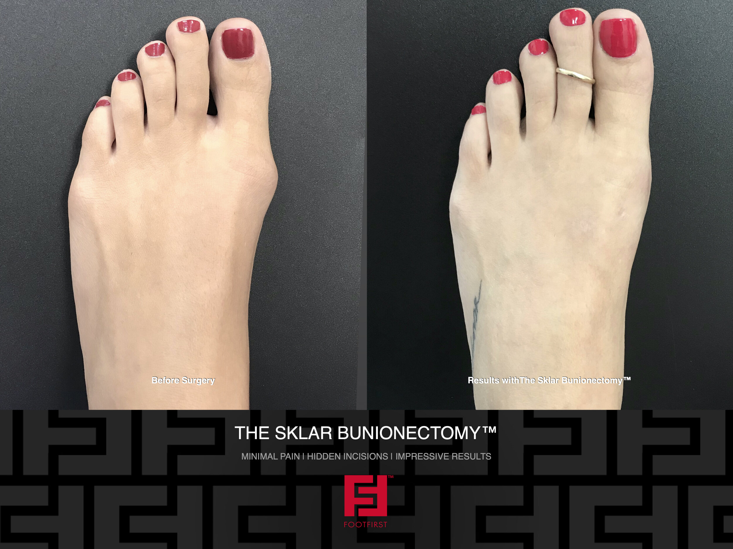 www.footfirst.com | Cosmetic Bunion and Toe Shortening Surgery Copyright FootFirst 50.jpeg