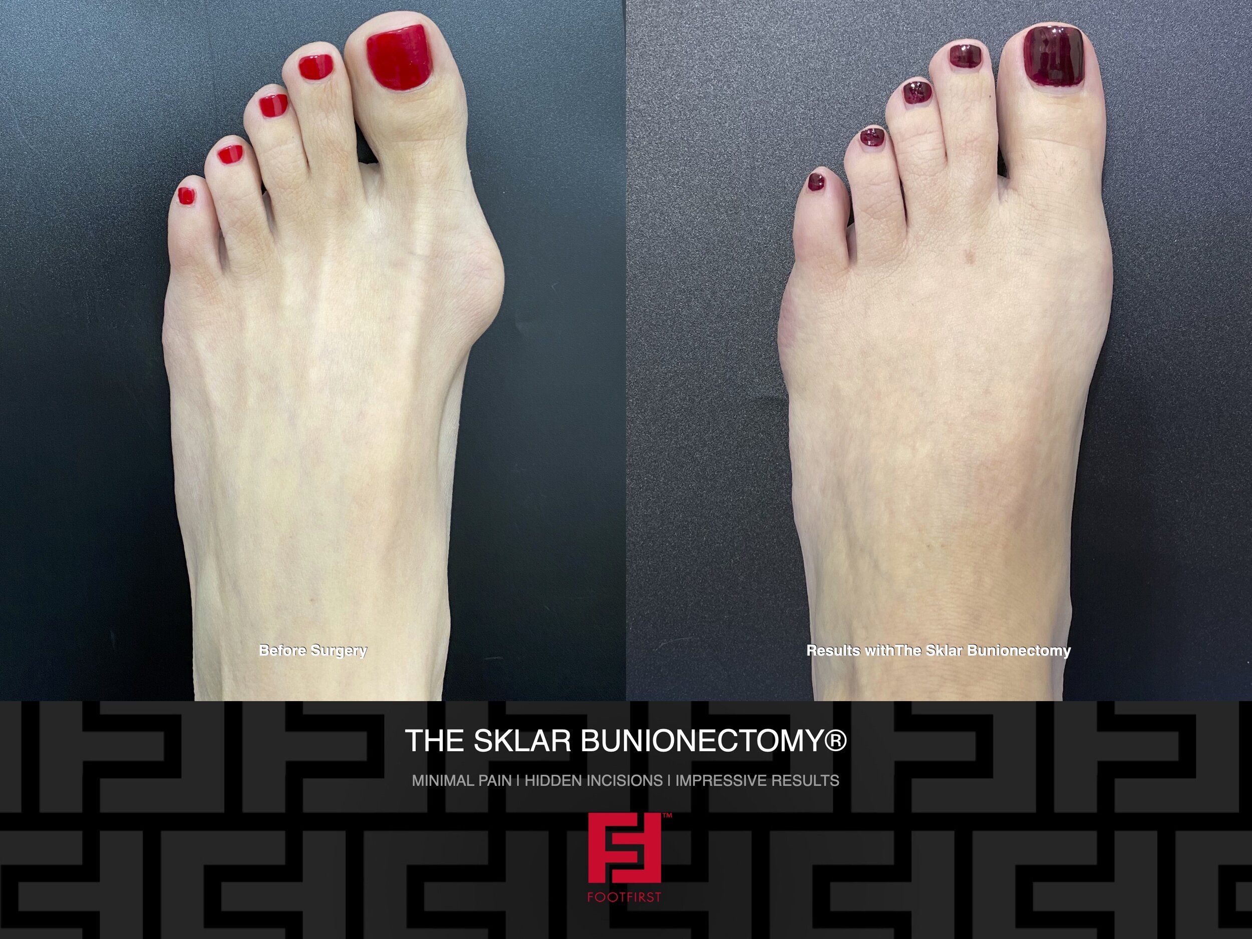 www.footfirst.com | Cosmetic Bunion and Toe Shortening Surgery Copyright FootFirst 97.jpeg