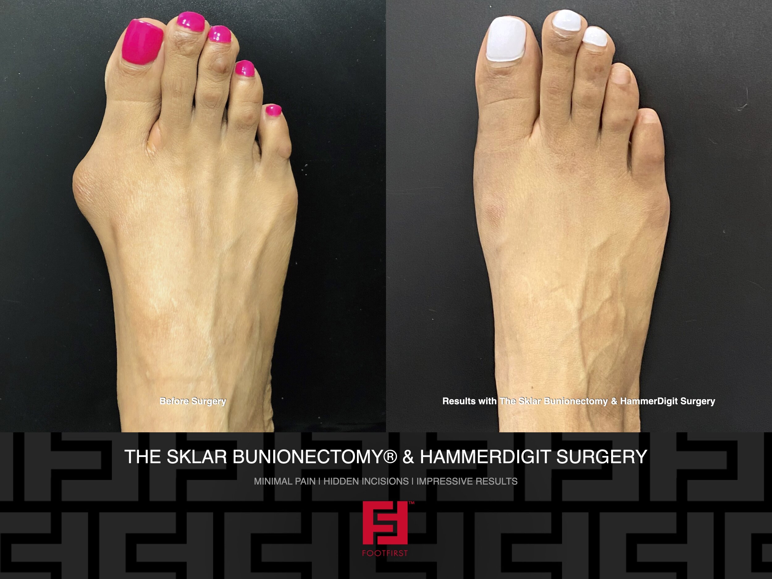 www.footfirst.com | Cosmetic Bunion and Toe Shortening Surgery Copyright FootFirst 96.jpeg