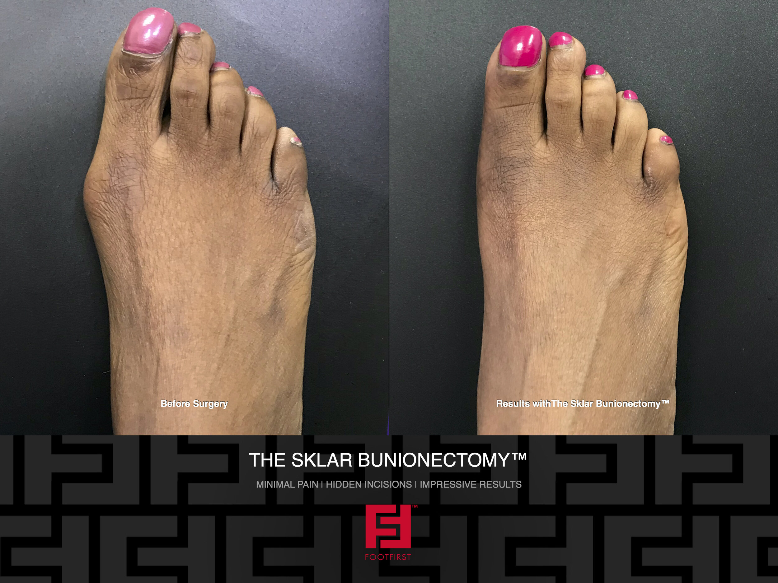 www.footfirst.com | Cosmetic Bunion and Toe Shortening Surgery Copyright FootFirst 333.jpeg