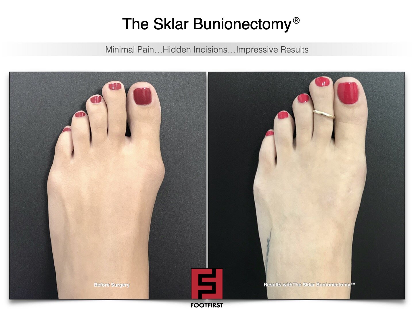 www.footfirst.com | Cosmetic Bunion and Toe Shortening Surgery COPYRIGHT FOOTFIRST 144.jpg