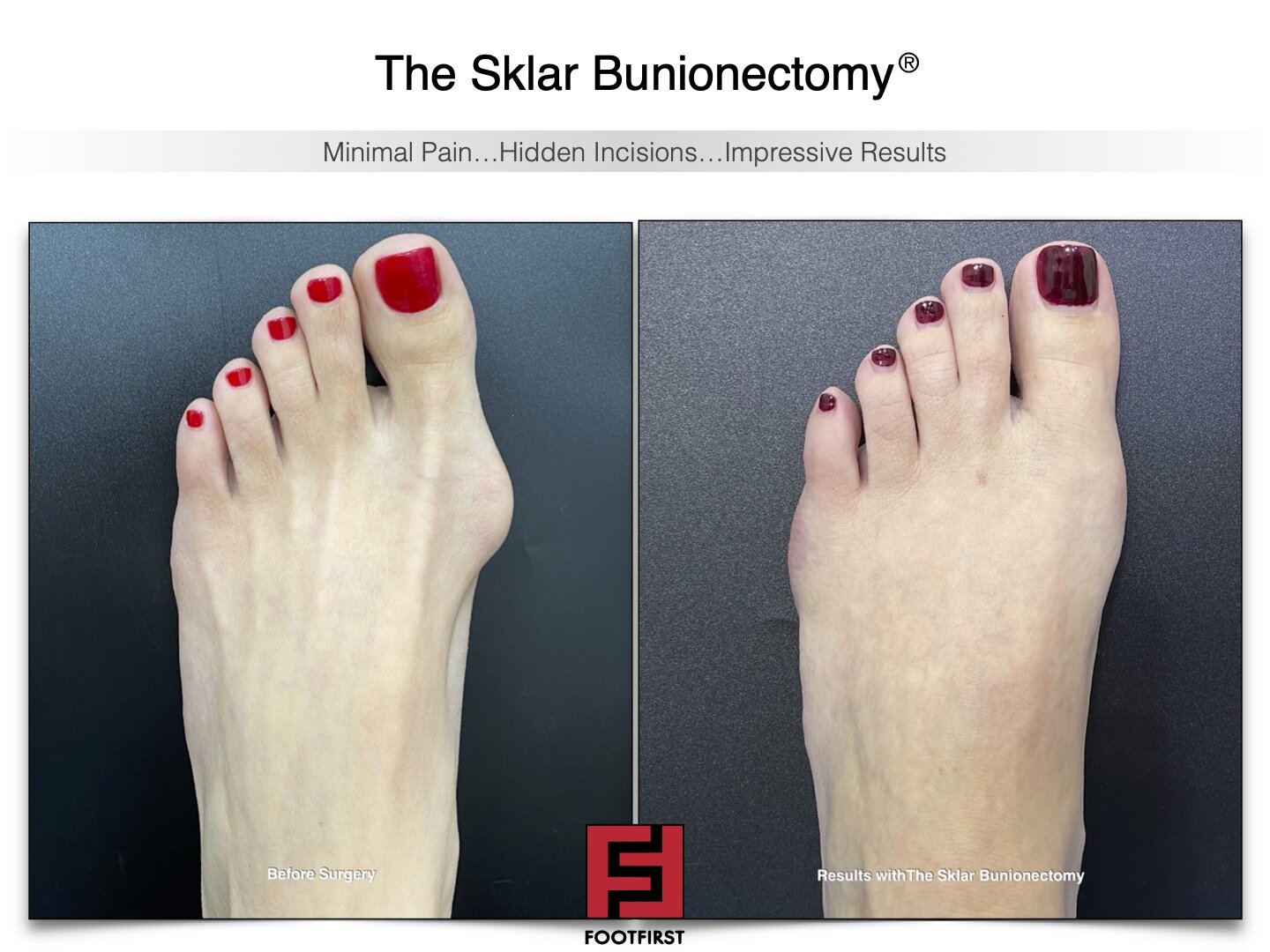 www.footfirst.com | Cosmetic Bunion and Toe Shortening Surgery COPYRIGHT FOOTFIRST 143.jpg