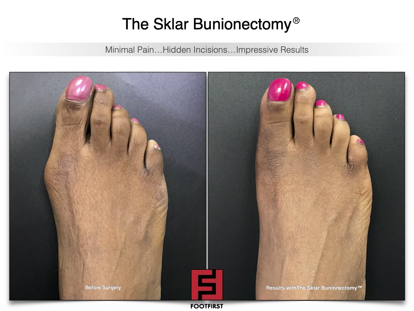 www.footfirst.com | Cosmetic Bunion and Toe Shortening Surgery COPYRIGHT FOOTFIRST 142.jpg