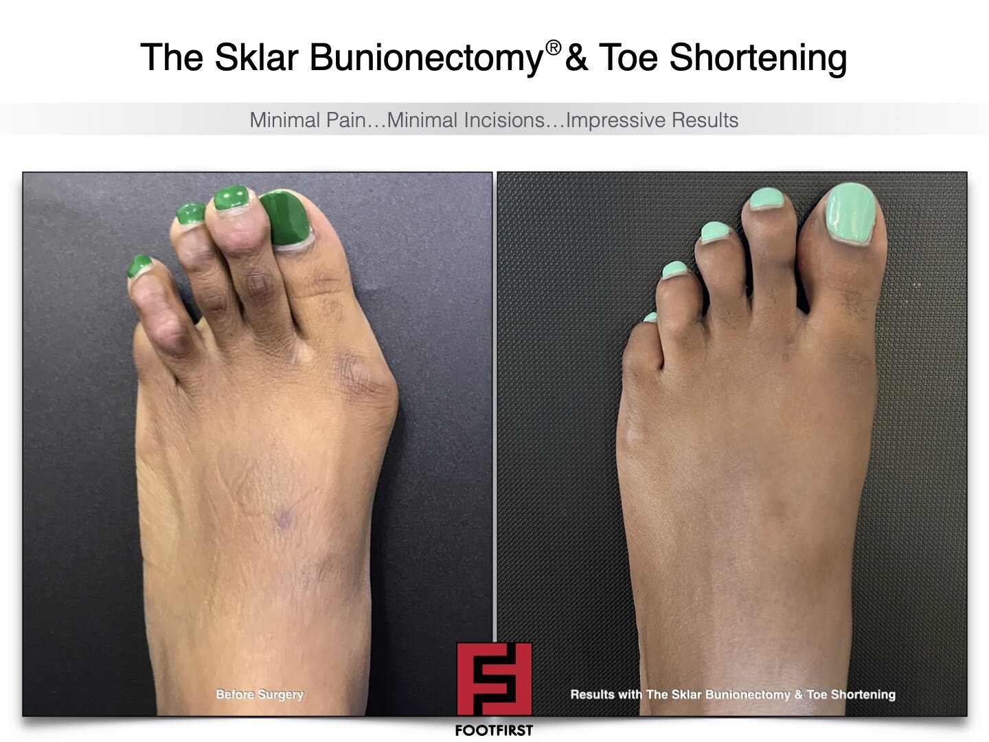 www.footfirst.com | Cosmetic Bunion and Toe Shortening Surgery COPYRIGHT FOOTFIRST 140.jpg