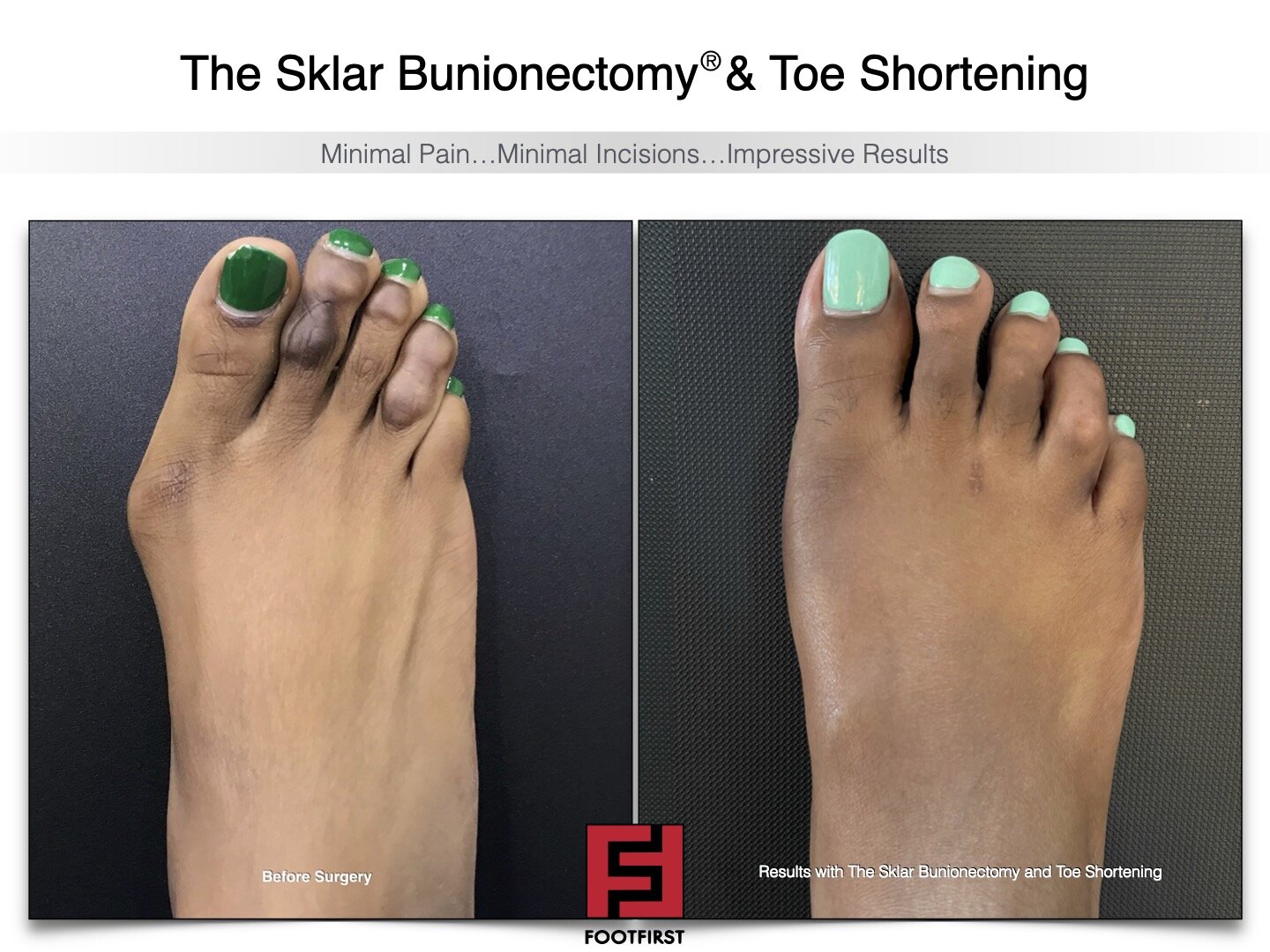 www.footfirst.com | Cosmetic Bunion and Toe Shortening Surgery COPYRIGHT FOOTFIRST 139.jpg