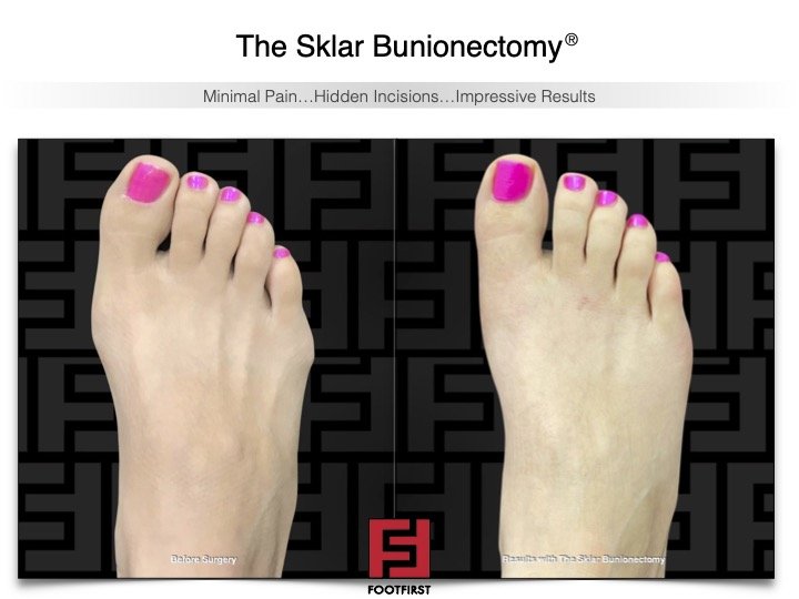 www.footfirst.com | Cosmetic Bunion and Toe Shortening Surgery 2.jpg