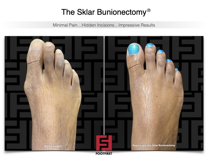 www.footfirst.com | Cosmetic Bunion and Toe Shortening Surgery 3.jpg