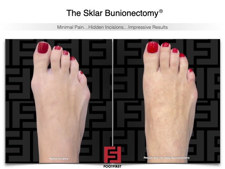 www.footfirst.com | Cosmetic Bunion and Toe Shortening Surgery 4.jpg