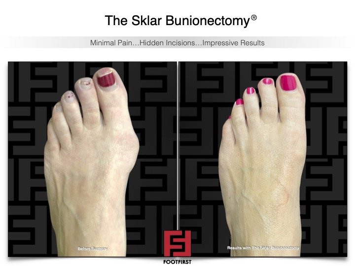 www.footfirst.com | Cosmetic Bunion and Toe Shortening Surgery 5.jpg