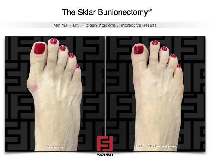 www.footfirst.com | Cosmetic Bunion and Toe Shortening Surgery 7.jpg