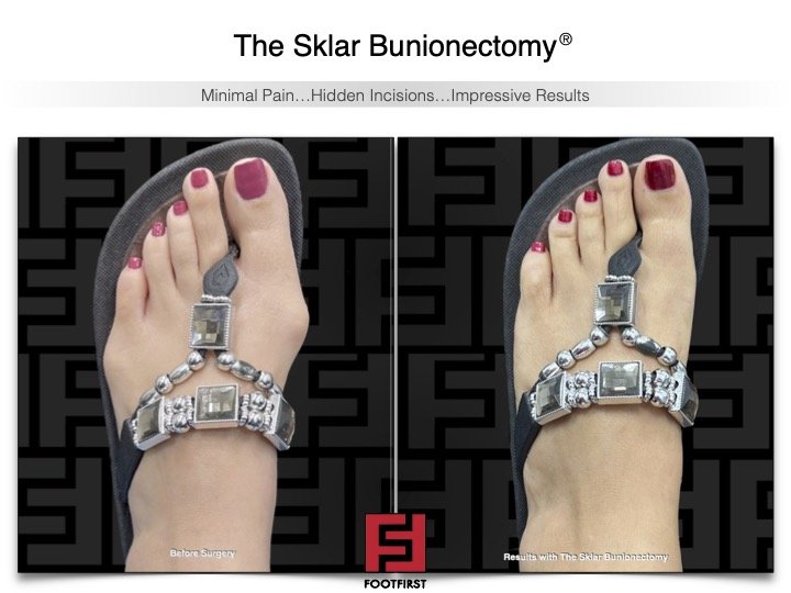 www.footfirst.com | Cosmetic Bunion and Toe Shortening Surgery 8.jpg