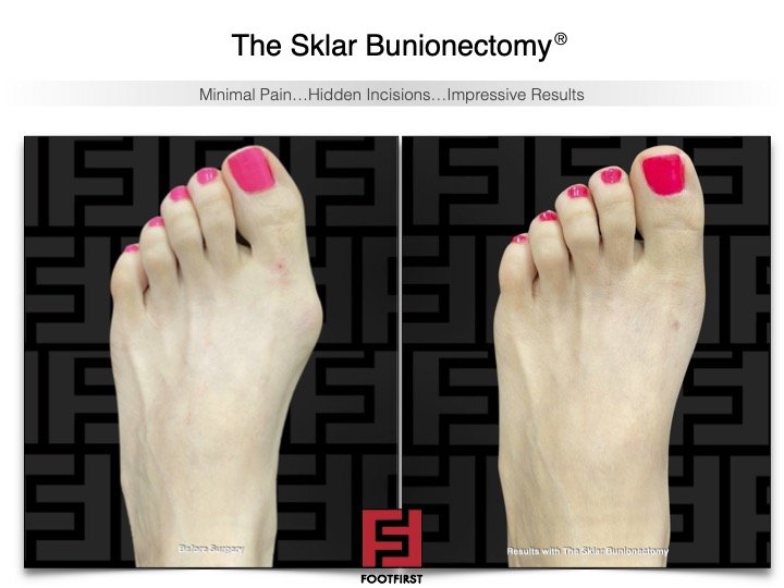 www.footfirst.com | Cosmetic Bunion and Toe Shortening Surgery 10.jpg