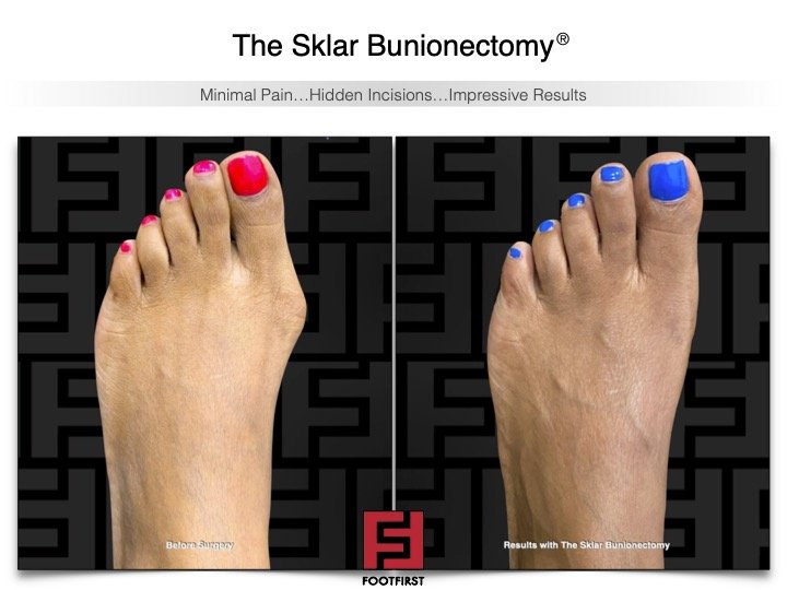 www.footfirst.com | Cosmetic Bunion and Toe Shortening Surgery 12.jpg