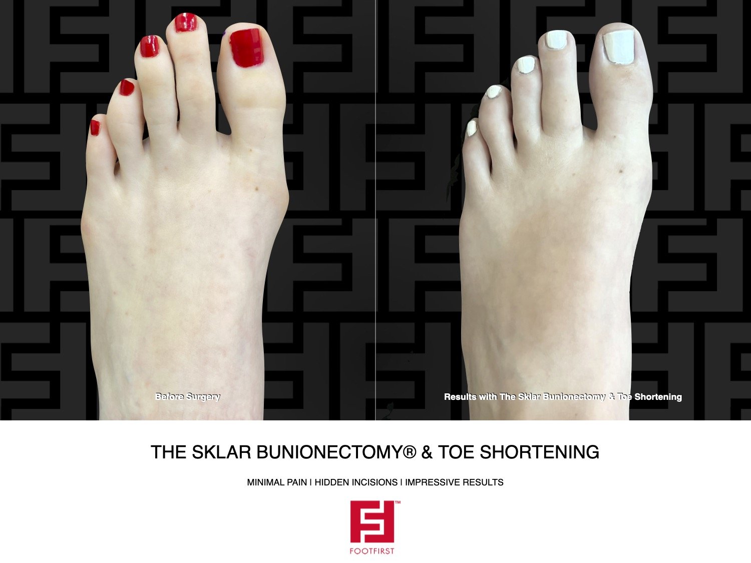 FF  www.footfirst.com - The Sklar Bunionectomy & Toe Shortening 01.2022 194[56].jpeg