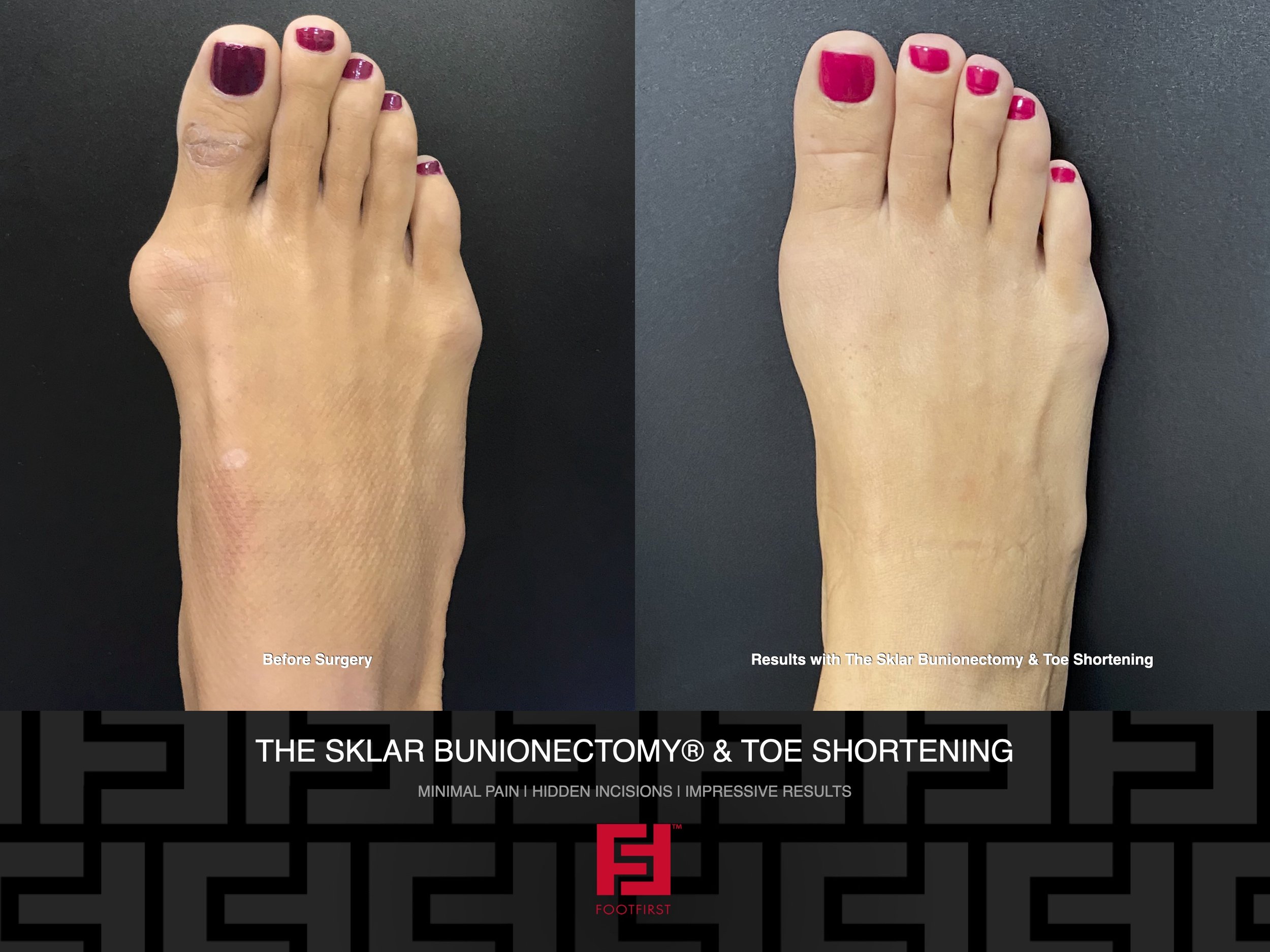 FF  www.footfirst.com - The Sklar Bunionectomy & Toe Shortening 12.2020 77[5].jpeg