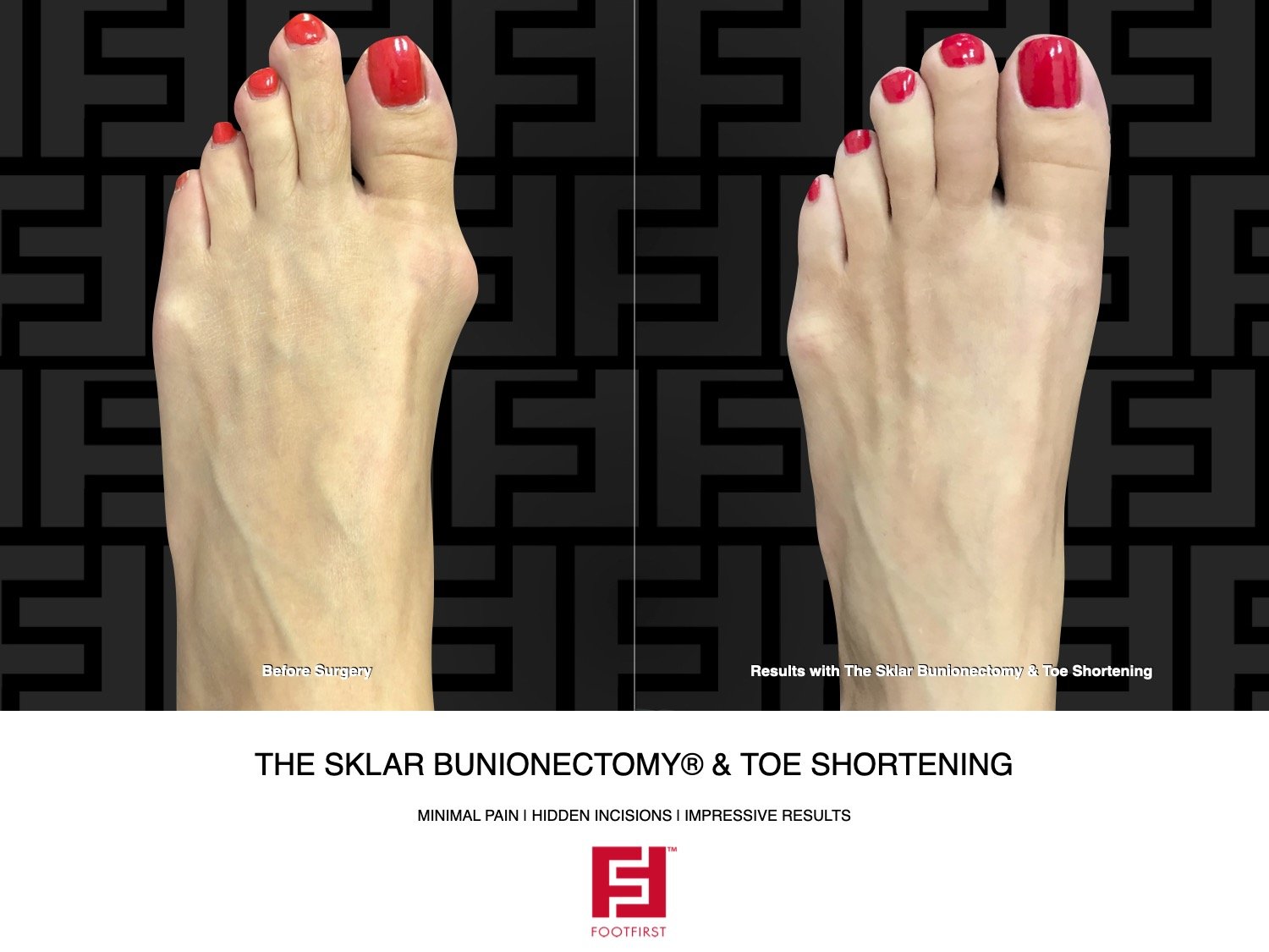 FF  www.footfirst.com - The Sklar Bunionectomy & Toe Shortening 01.2022 122[78].jpeg