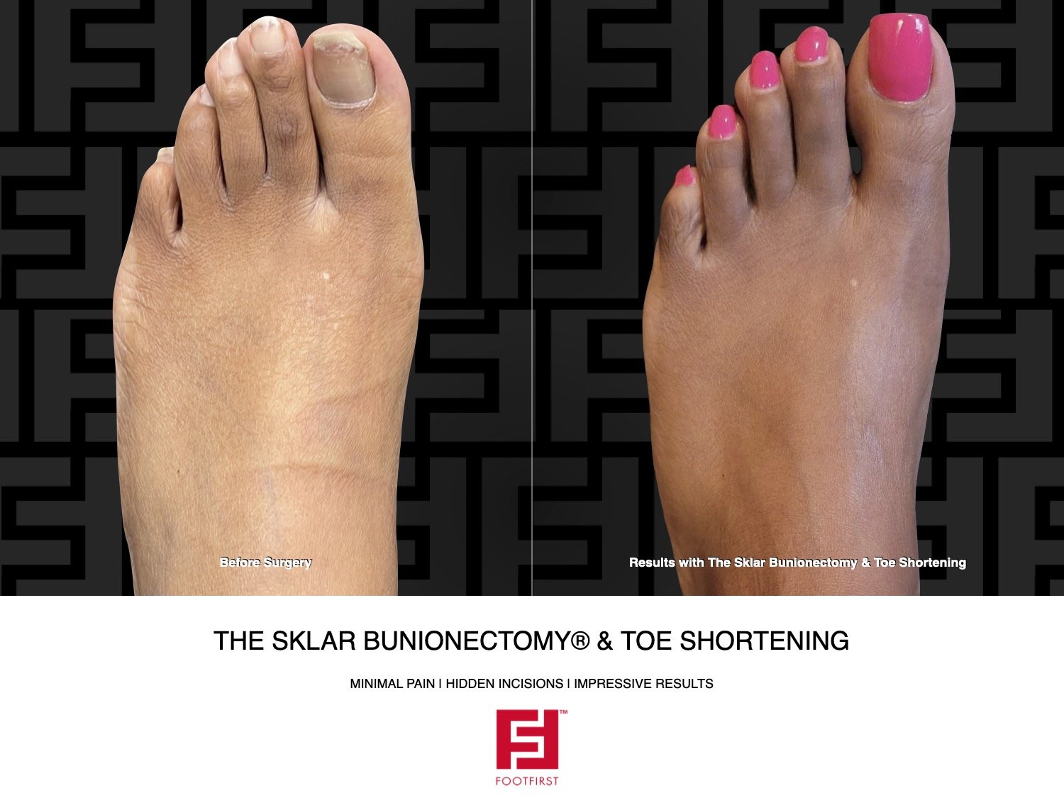 FF  www.footfirst.com - The Sklar Bunionectomy & Toe Shortening 11.2022 178[22].jpeg