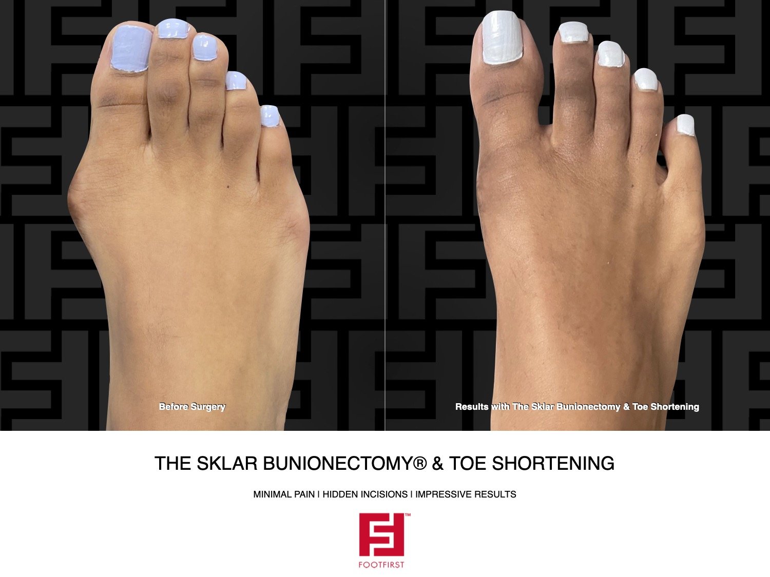 FF  www.footfirst.com - The Sklar Bunionectomy & Toe Shortening 11.2022 174[78].jpeg