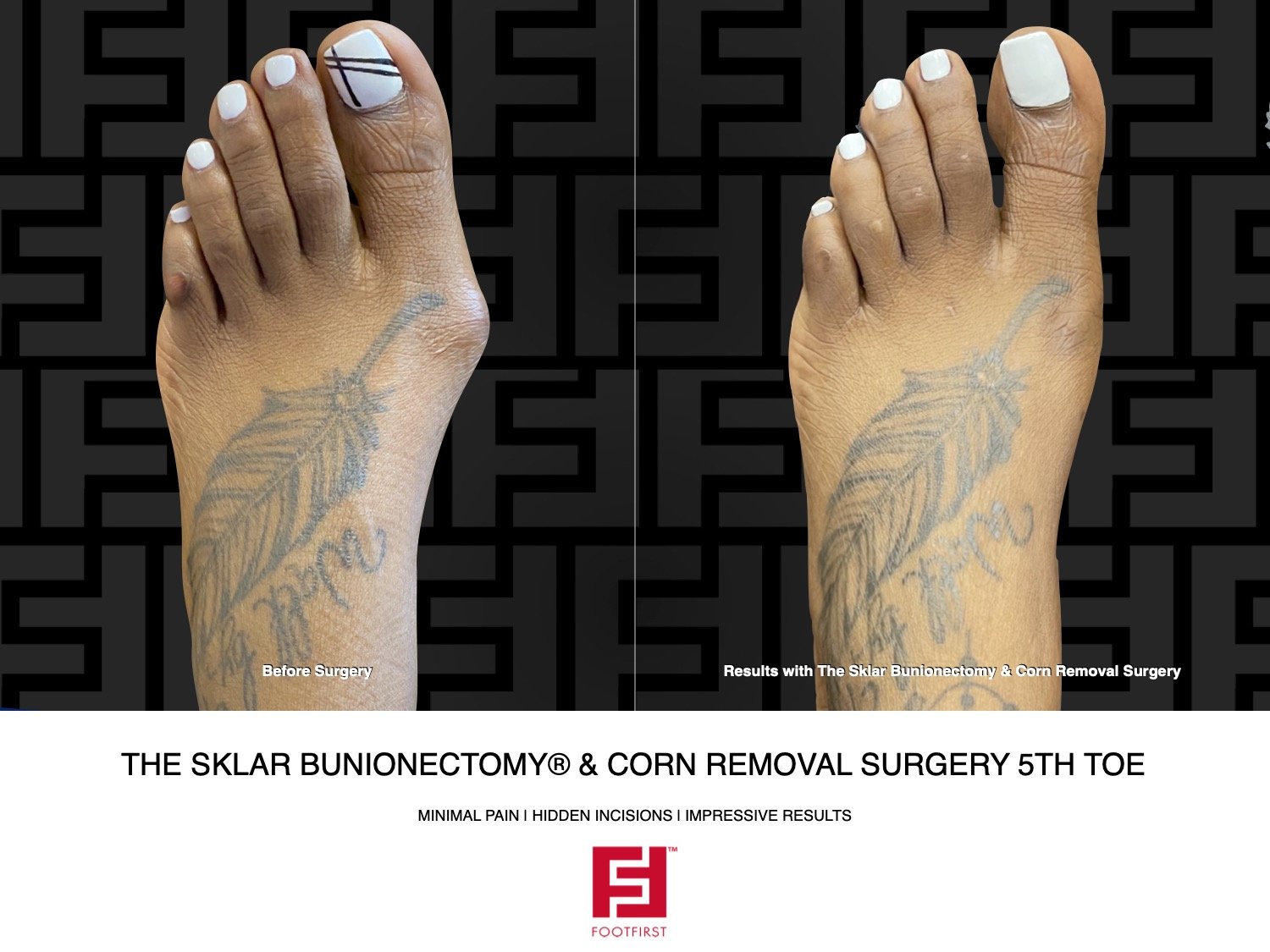 FF | www.footfirst.com - The Sklar Bunionectomy & Toe Shortening 12.2023  10.jpg