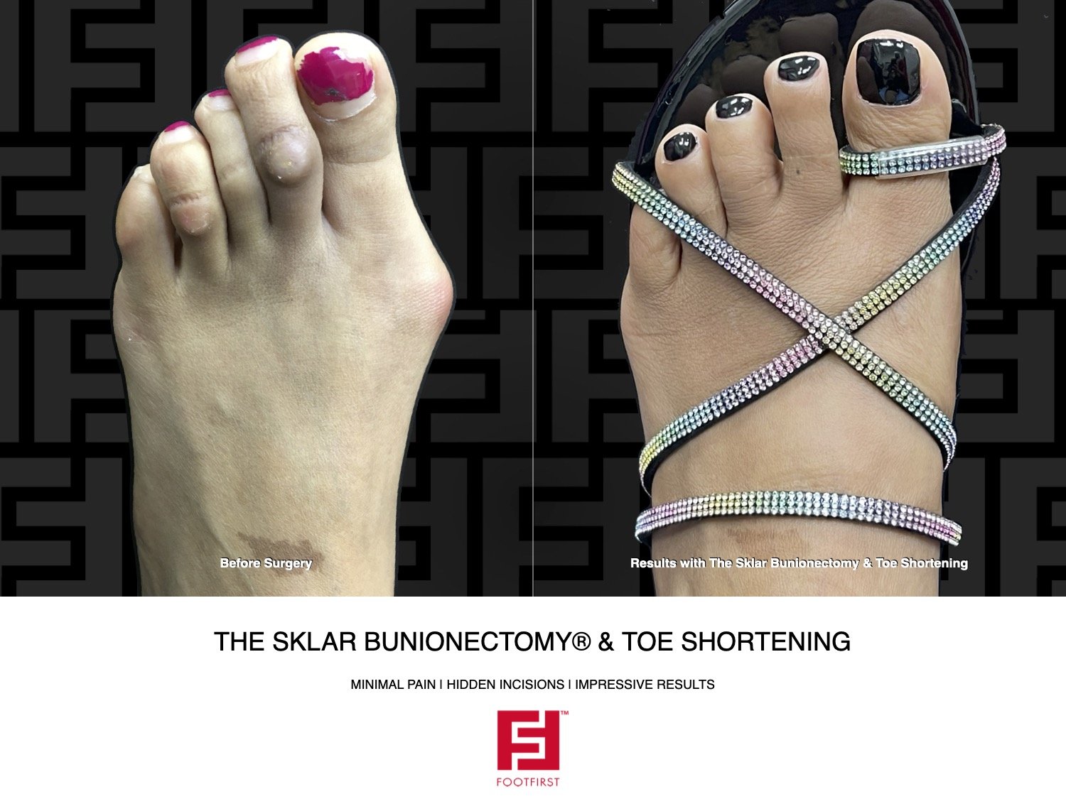 FF | www.footfirst.com - The Sklar Bunionectomy & Toe Shortening 12.2023  120.jpg