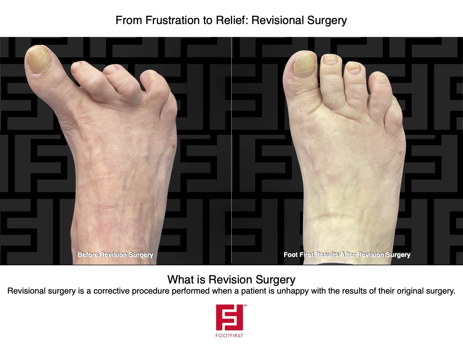 FF | www.footfirst.com - The Sklar Bunionectomy & Toe Shortening | Revision 1.jpg