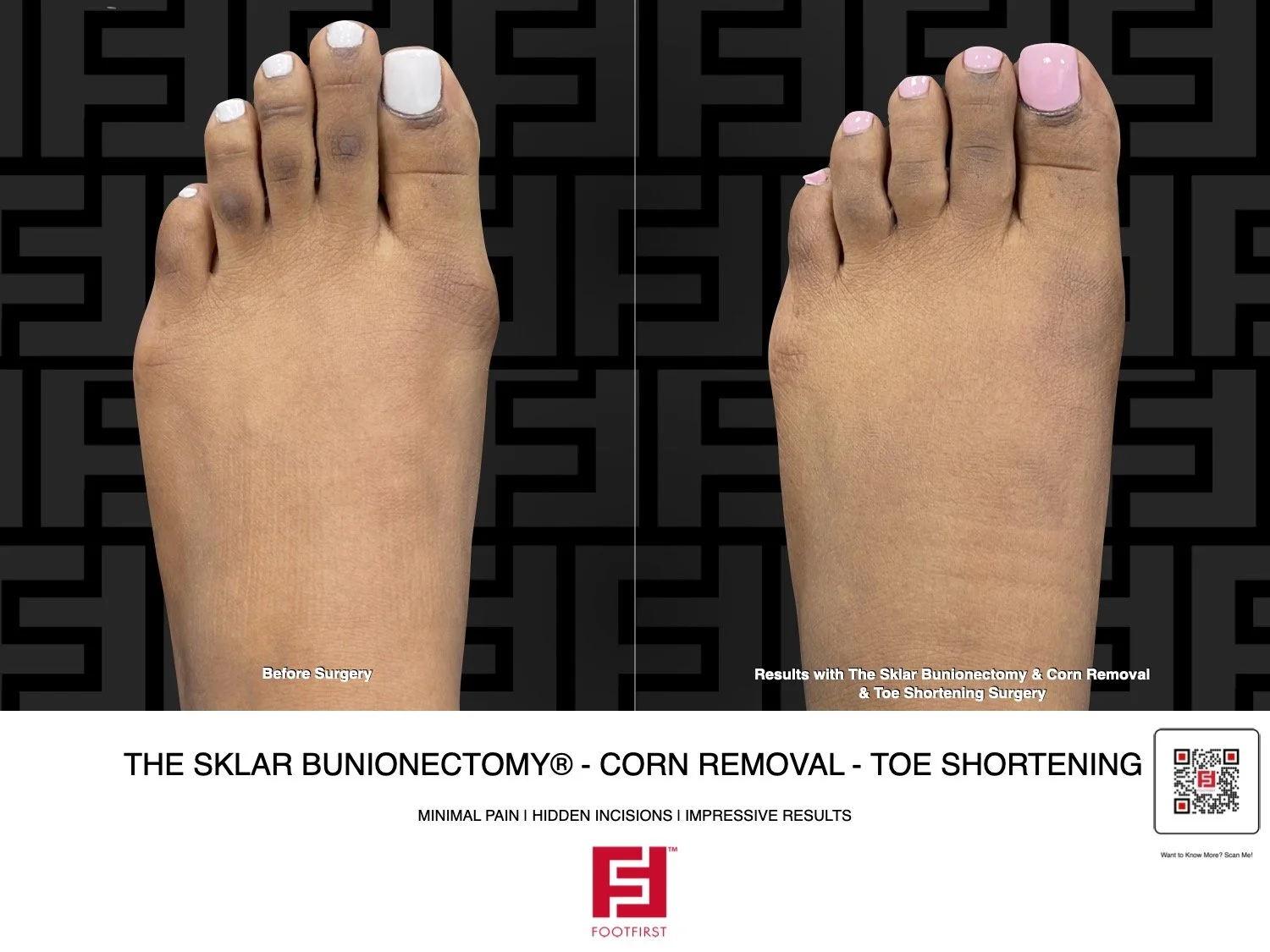 FF | www.footfirst.com - The Sklar Bunionectomy & Toe Shortening 01.2025 312.jpg