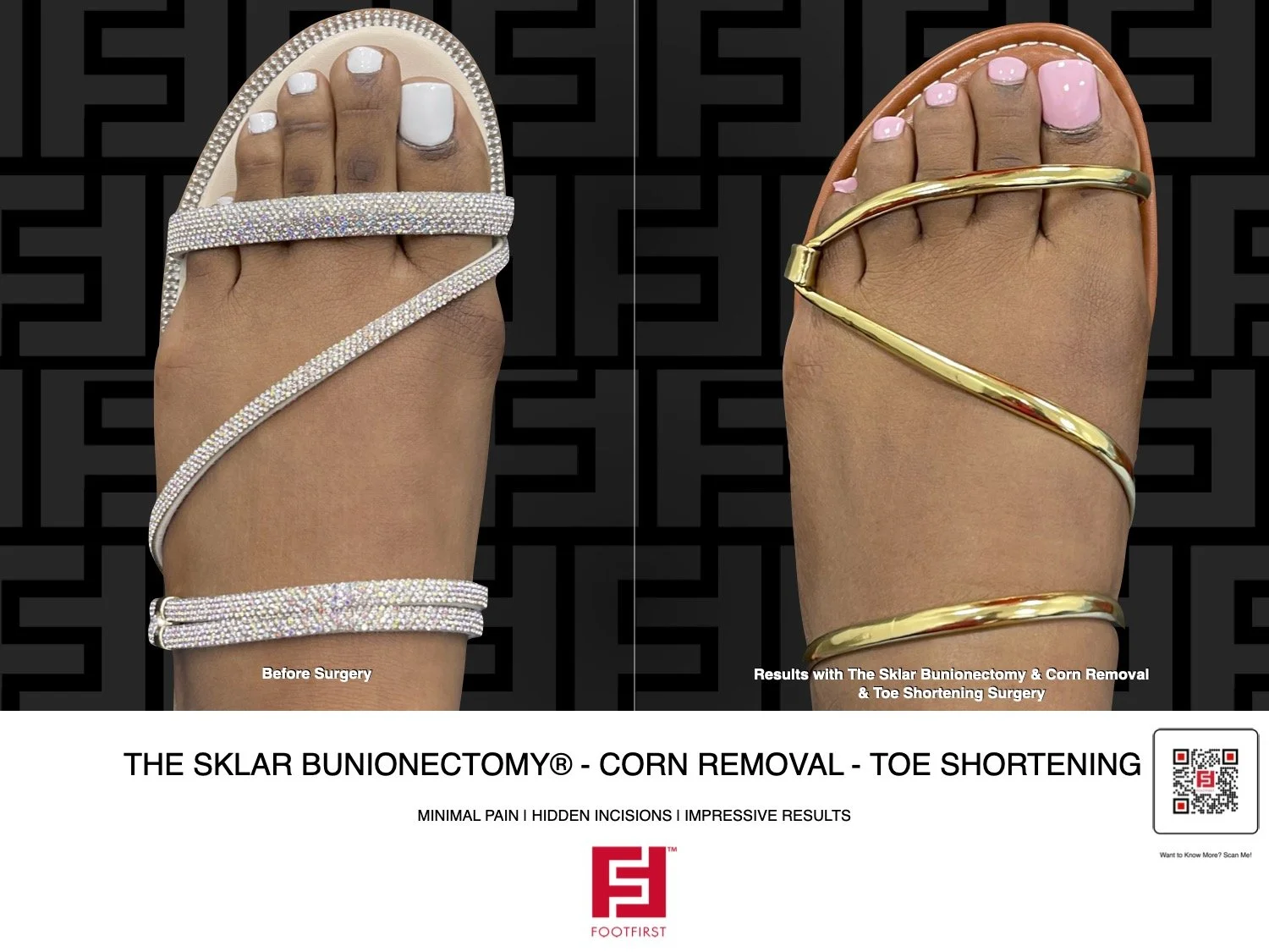 FF | www.footfirst.com - The Sklar Bunionectomy & Toe Shortening 01.2025 313.jpg