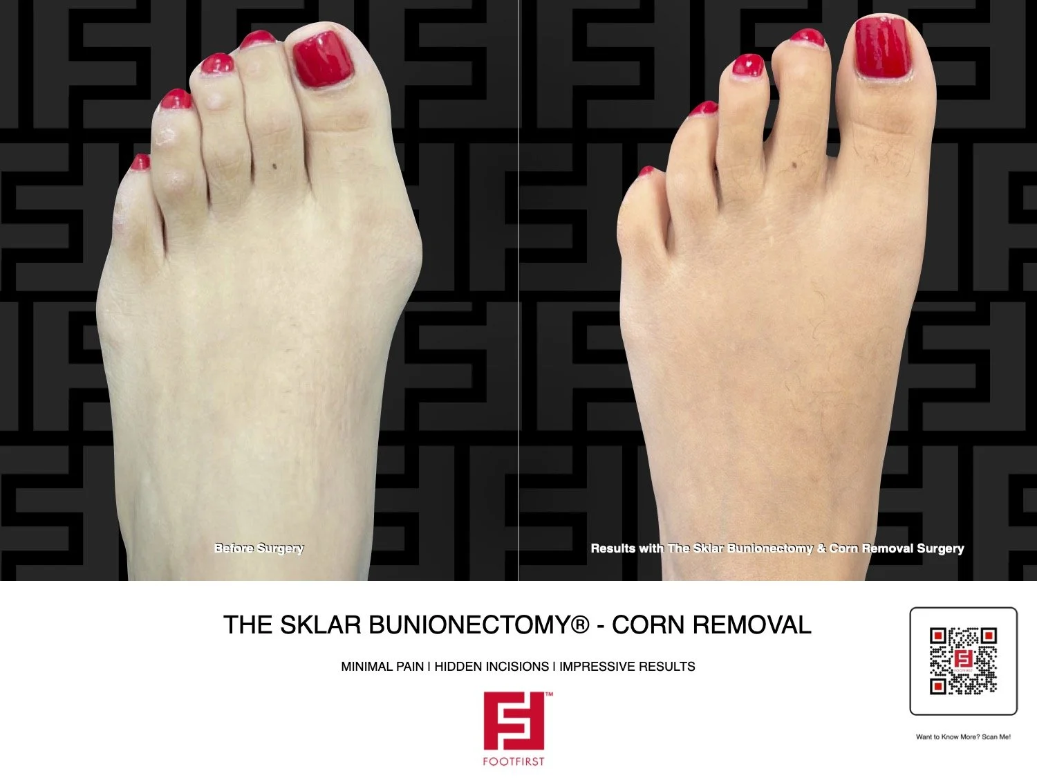 FF | www.footfirst.com - The Sklar Bunionectomy & Corn Removal 07.2025 38.jpg