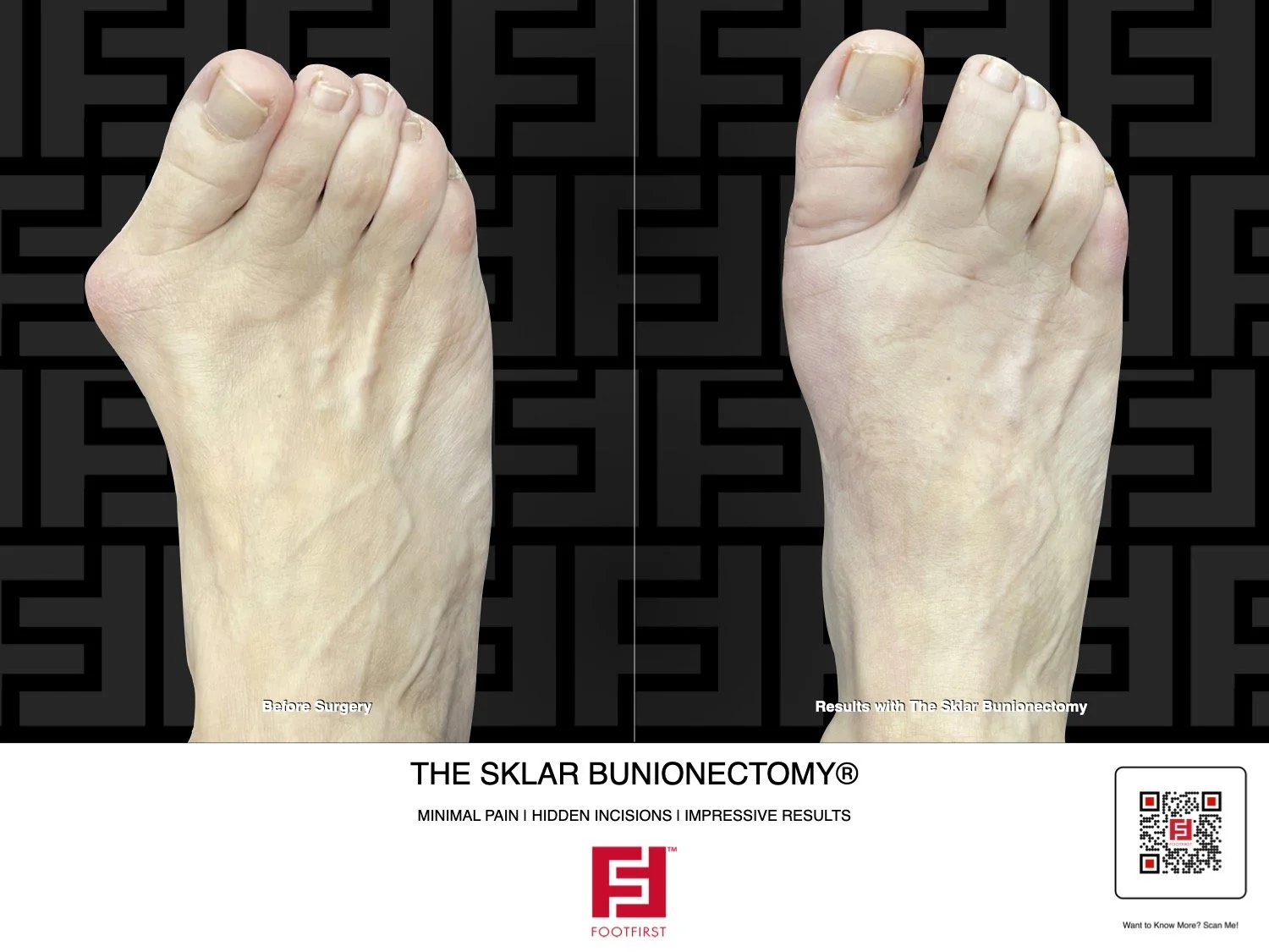 FF | www.footfirst.com - The Sklar Bunionectomy & Toe Shortening 07.2025 76.jpg