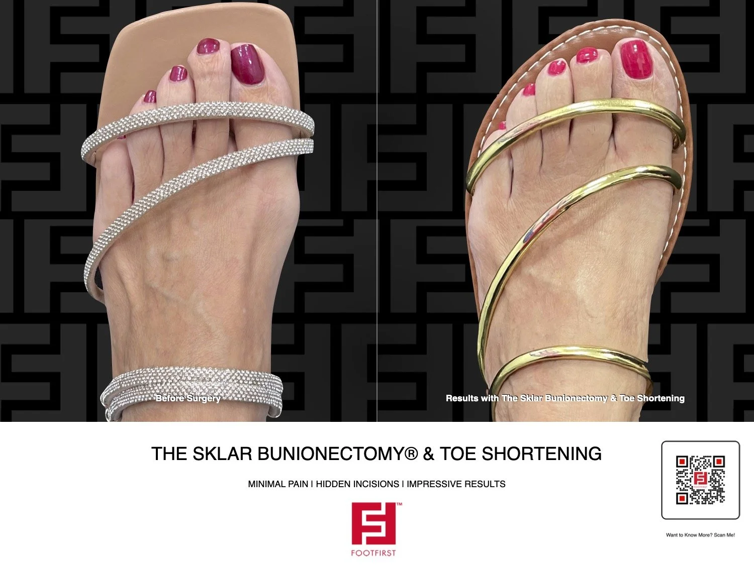 FF  www.footfirst.com - Bunion, Corns & Toe Shortening 07.2025 222.jpg.jpeg