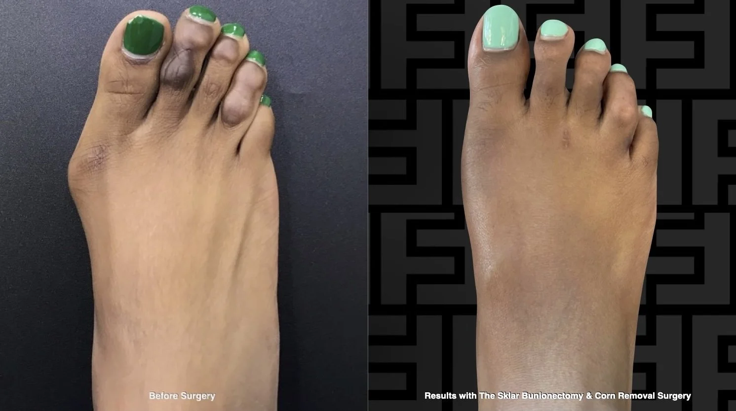 Minimally Invasive Corn Removal Surgery at Foot First Podiatry