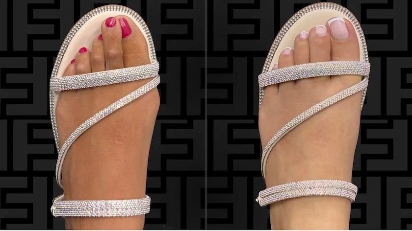 The Sklar Bunionectomy® vs. Minimally Invasive (“Pinhole”) Bunion Surgery: Key Differences and Outcomes