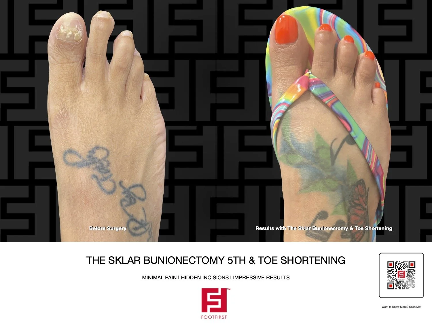 FF | www.footfirst.com - Sklar Bunionectomy - Bunion - Corn Removal - Cosmetic - Toe Shortening .jpg