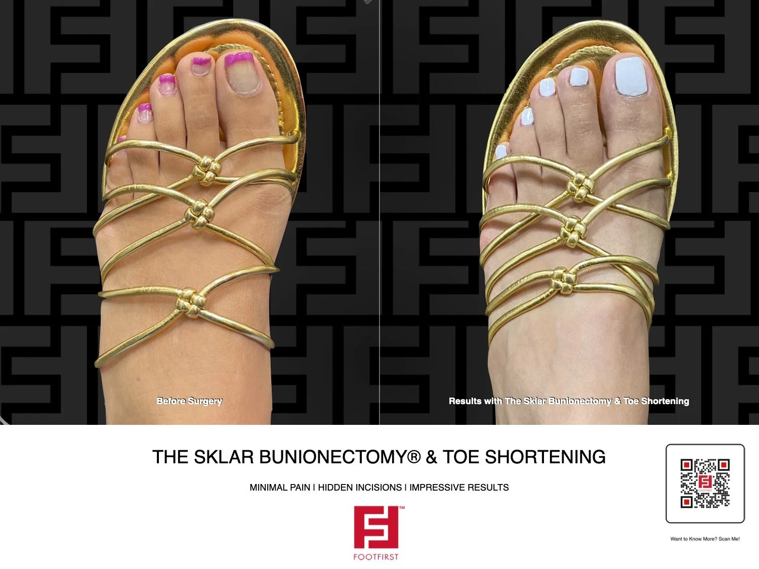 FF | www.footfirst.com - Sklar Bunionectomy - Bunion - Corn Removal - Cosmetic - Toe Shortening .jpg