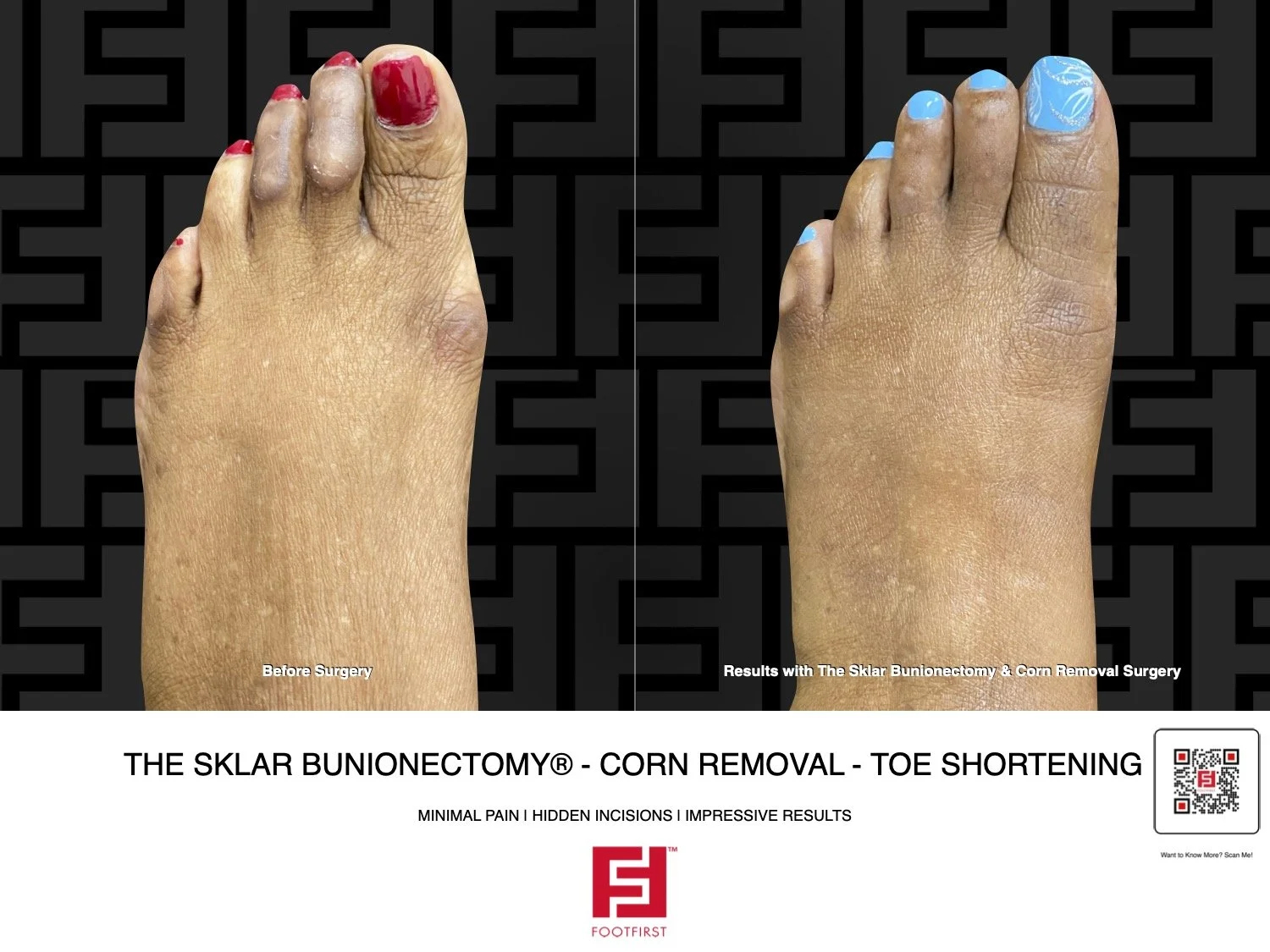 bunion corns.jpg