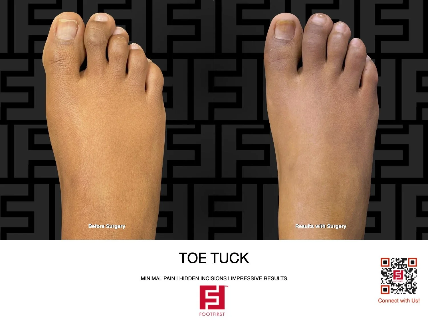 FF | www.footfirst.com - Bunion, Corns & Toe Shortening 01.2026 145.jpg