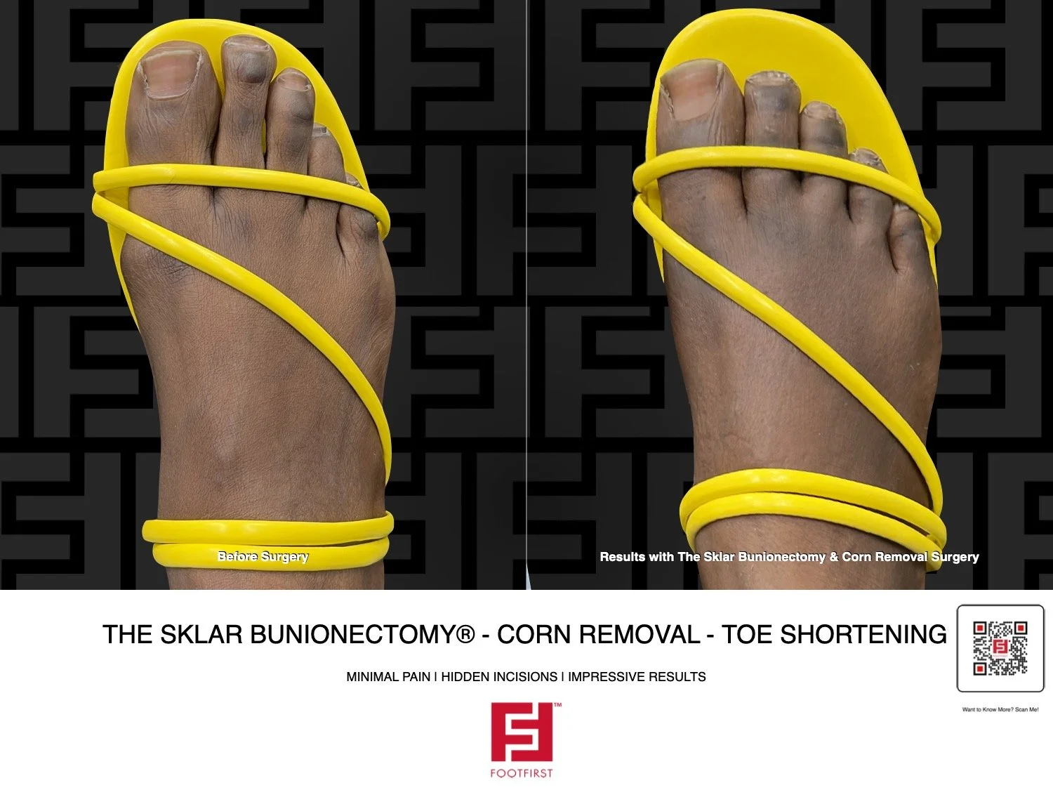 FF  www.footfirst.com - Bunion, Corns & Toe Shortening 01.2026 HAG 182.jpg.jpeg