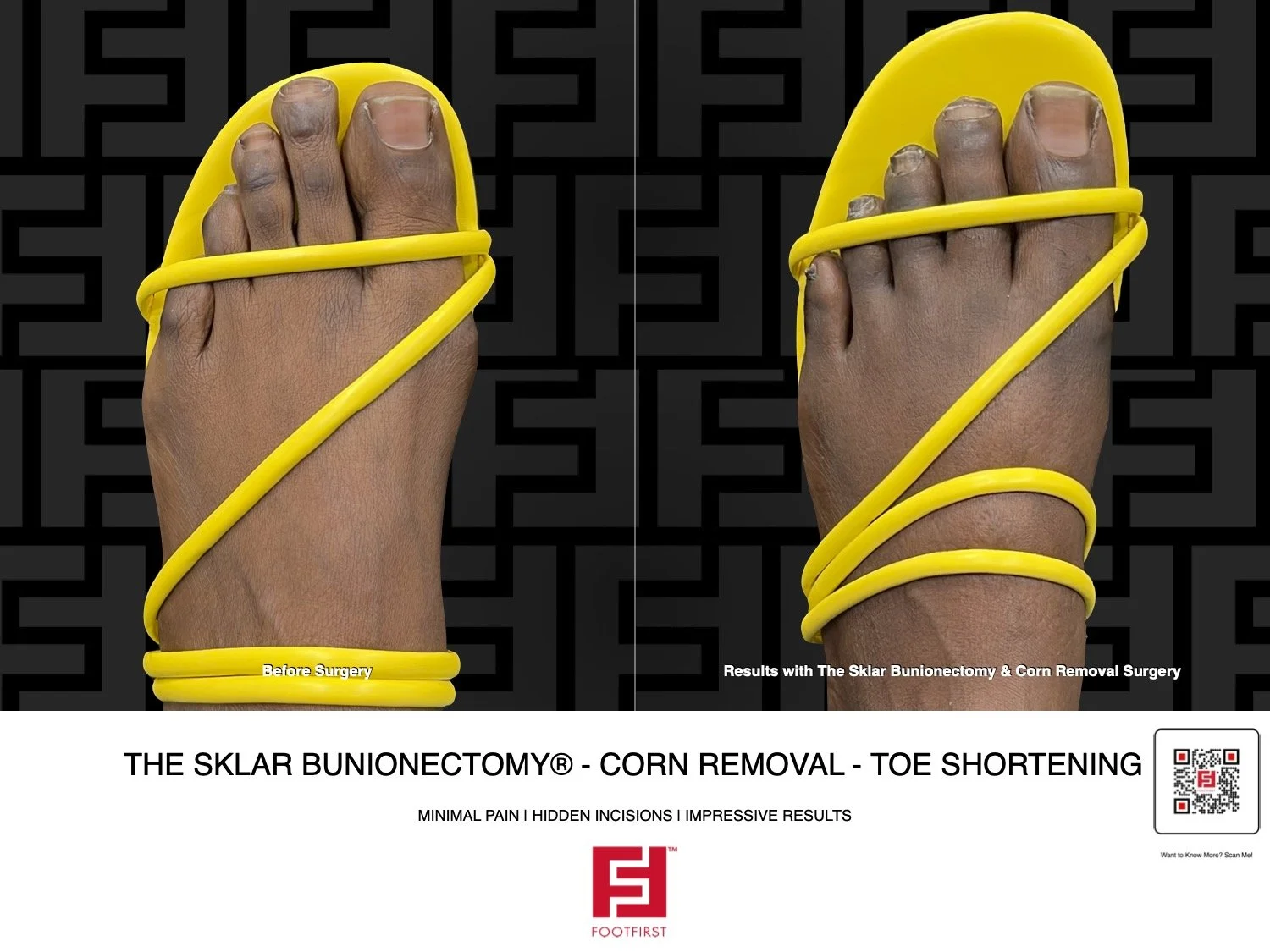 FF  www.footfirst.com - Bunion, Corns & Toe Shortening 01.2026 HAG 181.jpg.jpeg